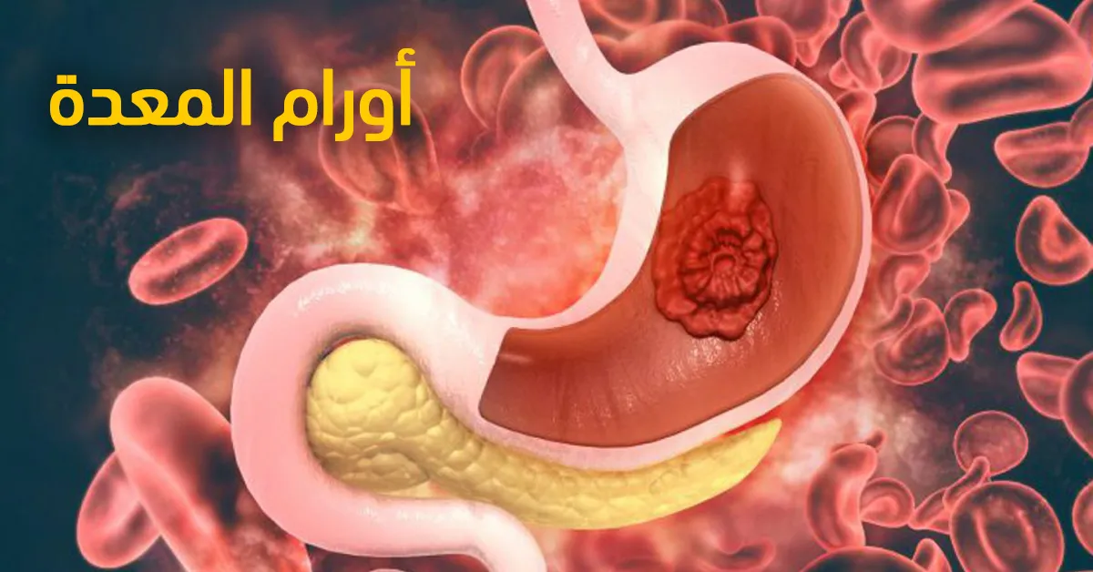 أورام المعدة